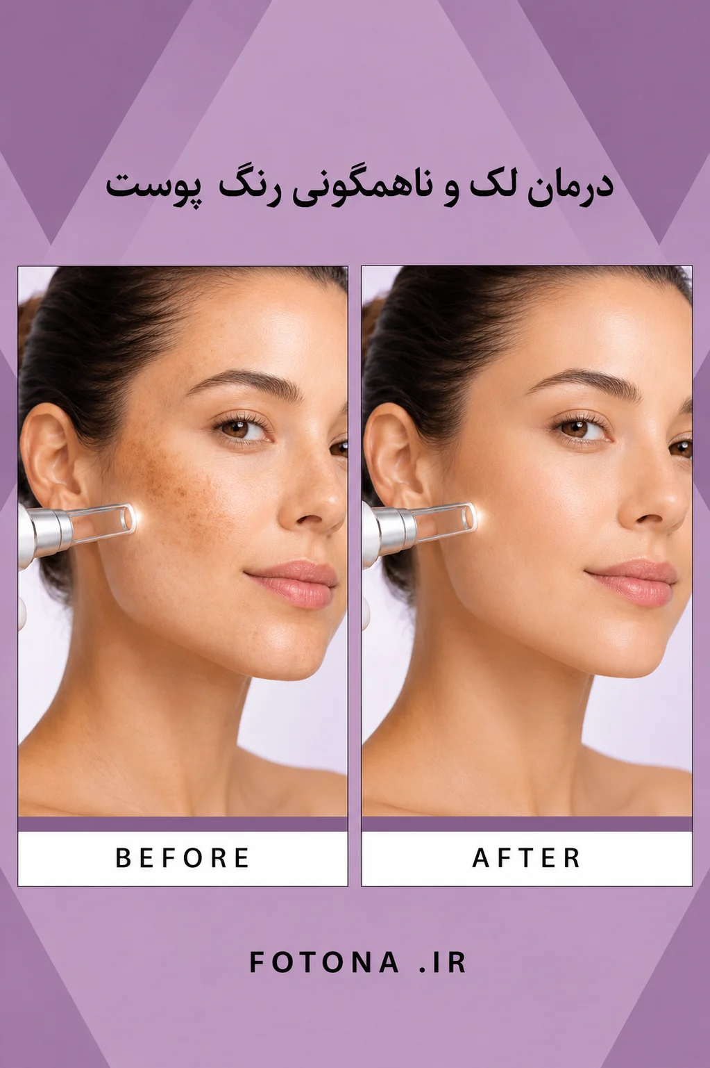 لیزر فوتونا برای تیرگی و لک پوست