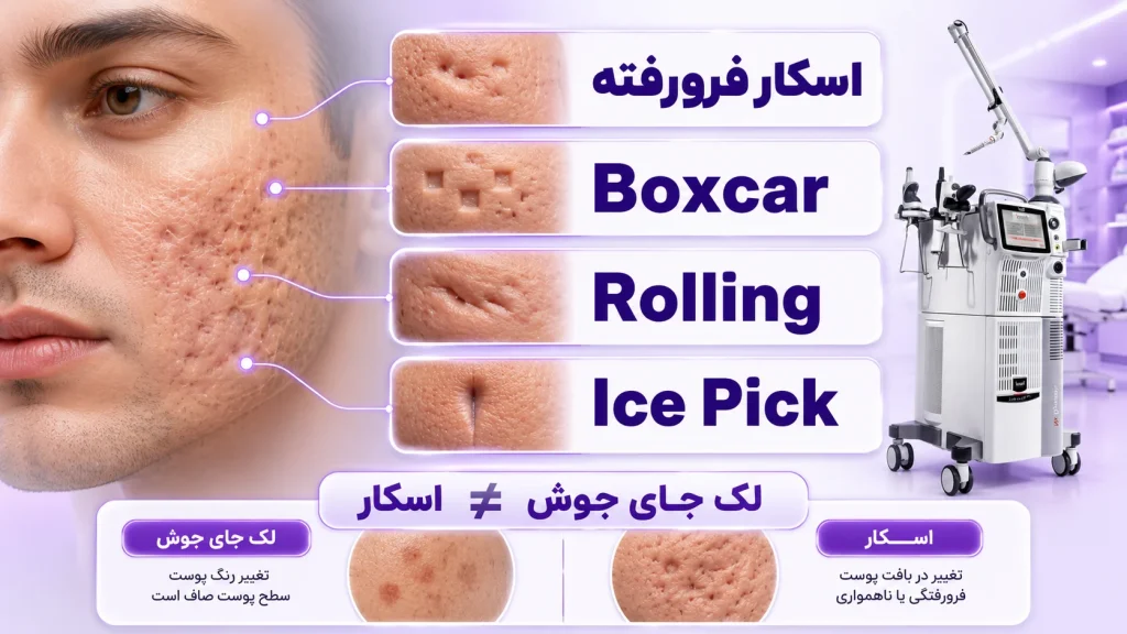 انواع اسکار ناشی از آکنه و تفاوت آن با لک جای جوش