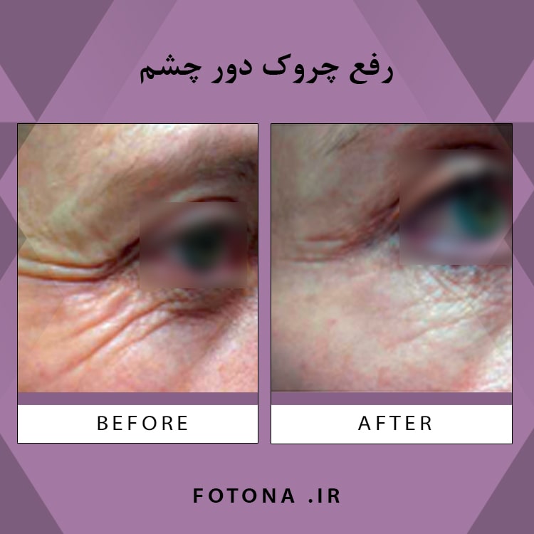 رفع چروک دور چشم با لیزر فوتونا