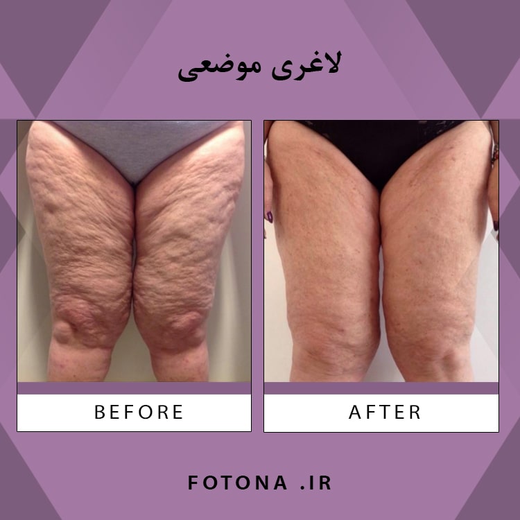 درمان سلولیت و فرم‌دهی موضعی با لیزر فوتونا