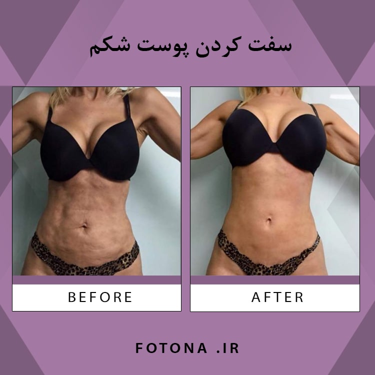 رفع ترک پوستی با لیزر فوتونا