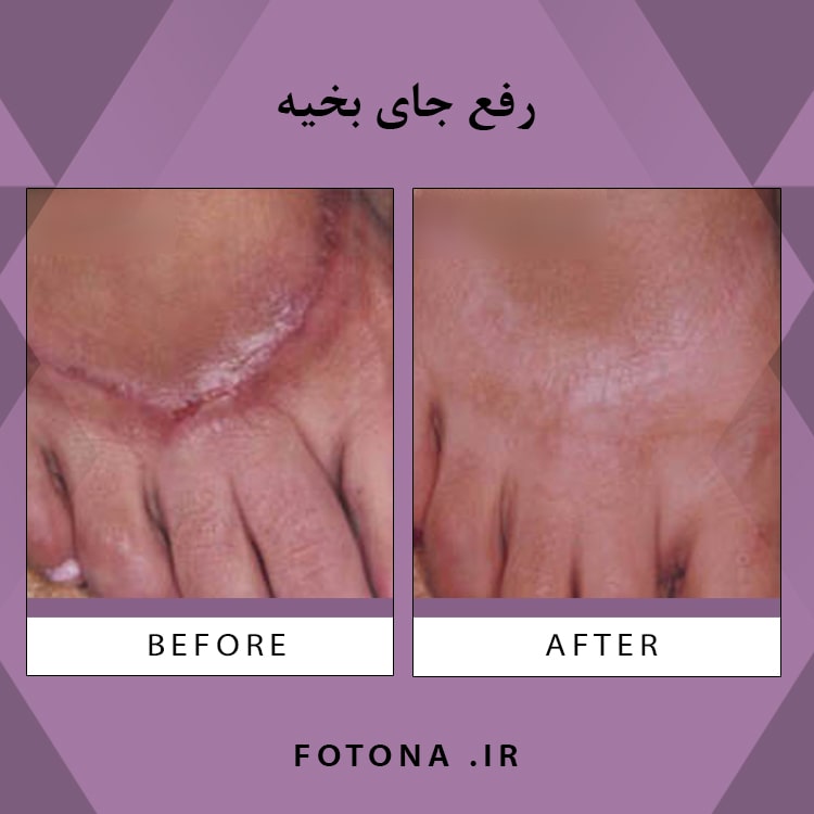 رفع جای بخیه و اسکار جراحی با لیزر فوتونا