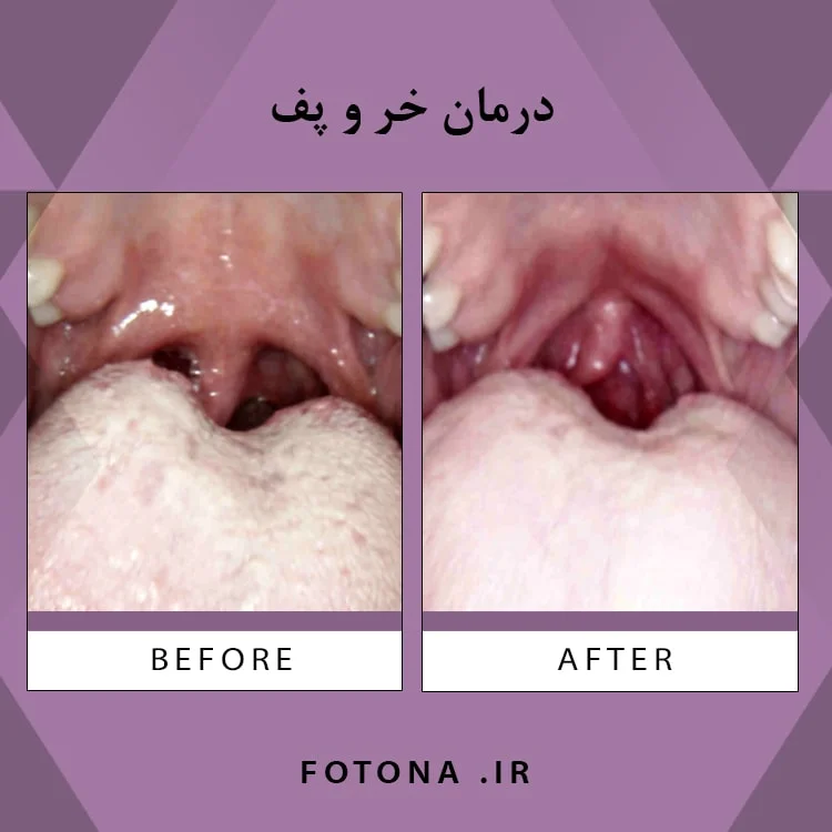 پیگیری درمان کام نرم و تنفس در خواب تصویر آموزشی پیگیری درمان کام نرم و اختلالات تنفسی خواب