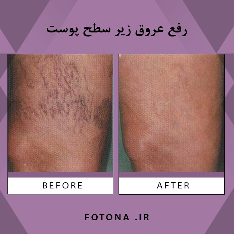 درمان عروق سطحی پوست با لیزر فوتونا